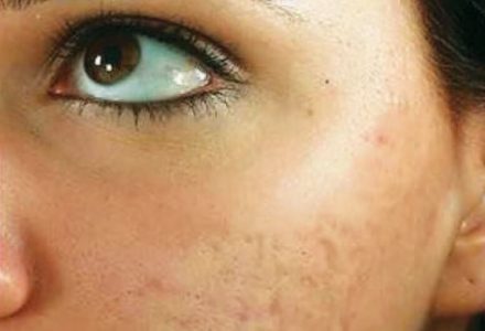 Acne Scars