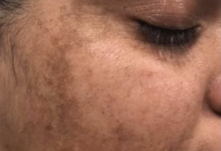 Pigmentation